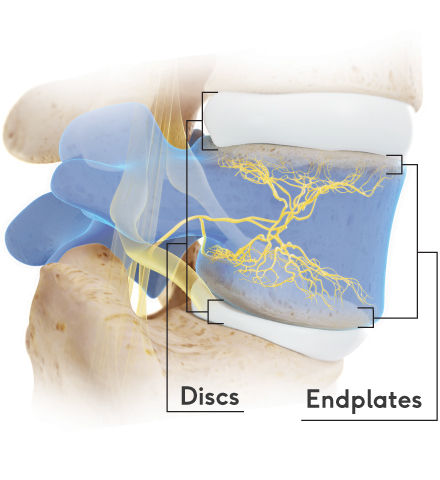 Pain-endplates-and-discs BVN