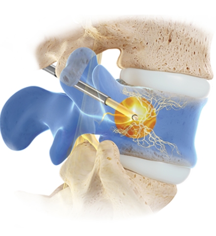 Probe-in-bone