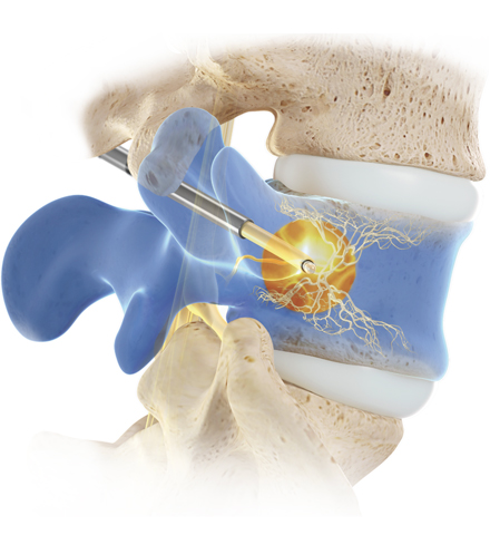 Intercept Basivertebral Nerve Ablation