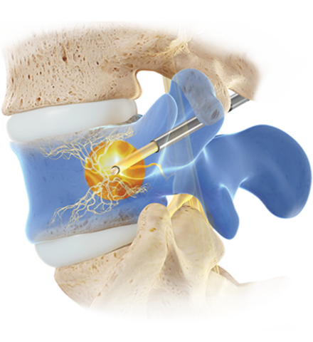 Intracept-Procedure-Probe-In-Bone-image